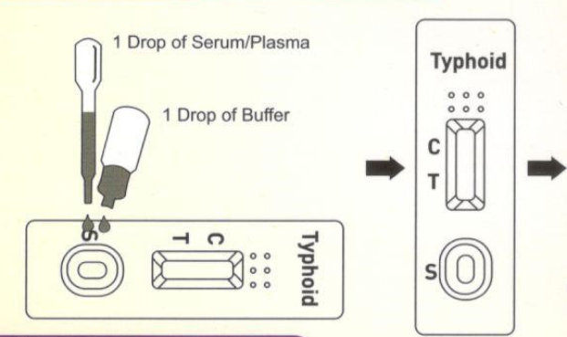 Typhoid